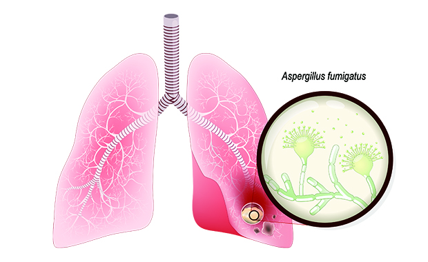肺真菌症について 横浜弘明寺呼吸器内科クリニック健康情報局